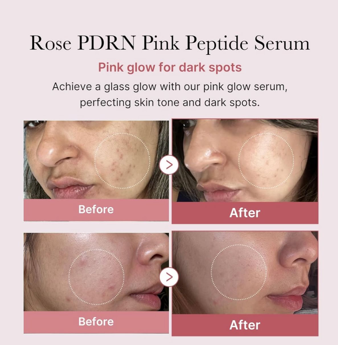 PINK SERUMS™ ⭐⭐⭐⭐⭐Elimina el acné y líneas de expresión