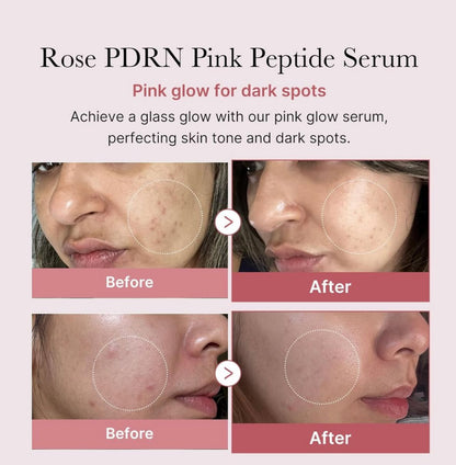 PINK SERUMS™ ⭐⭐⭐⭐⭐Elimina el acné y líneas de expresión